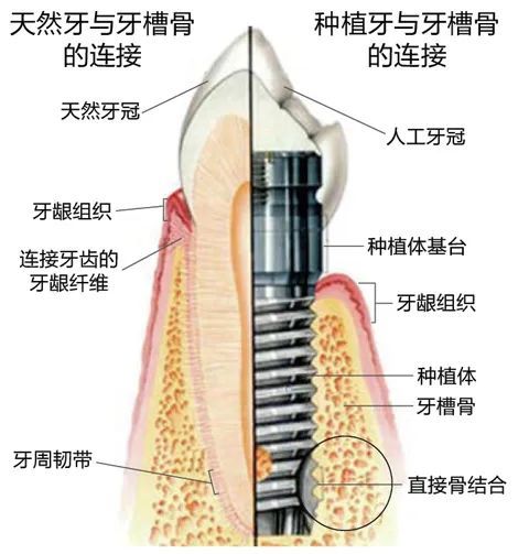 种植牙凭什么卖这么贵，质量到底如何，与真牙的区别是什么? 图片-13