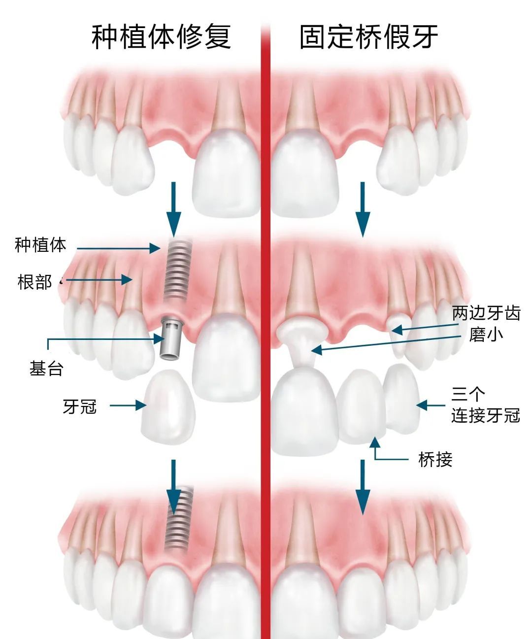 种植牙凭什么卖这么贵，质量到底如何，与真牙的区别是什么? 图片-11