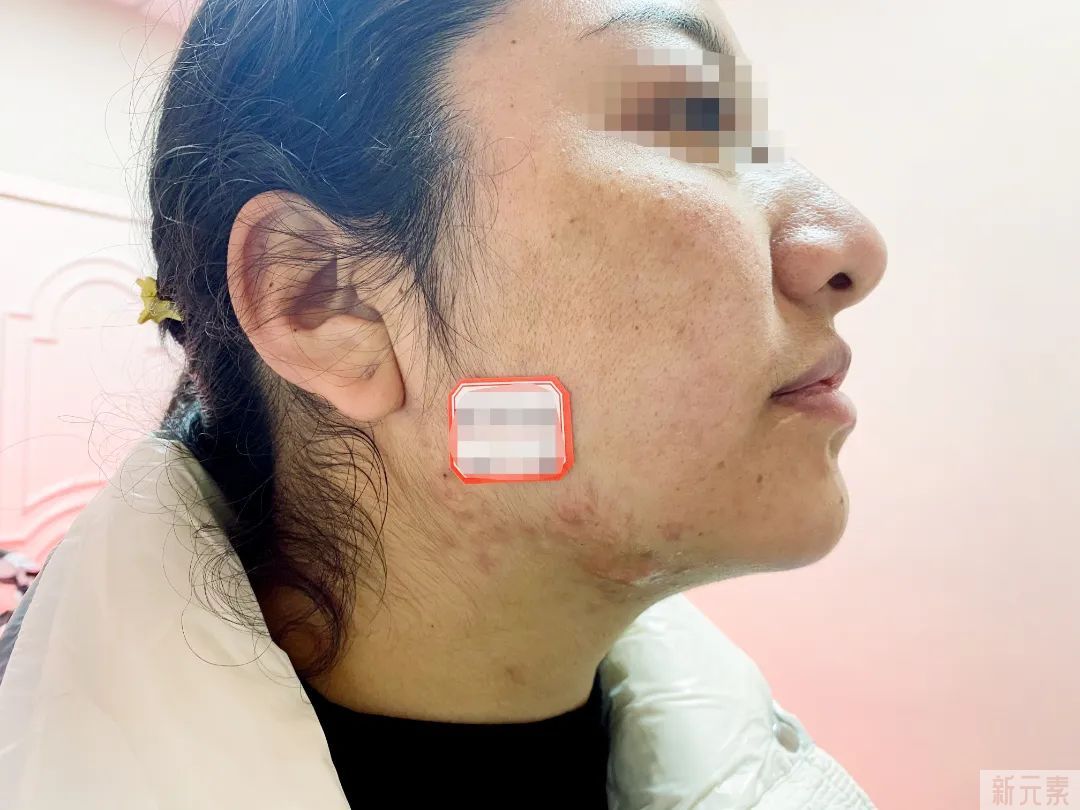 如何分辨增生疤痕和疤痕疙瘩?一文教你鉴别~ 图片-7
