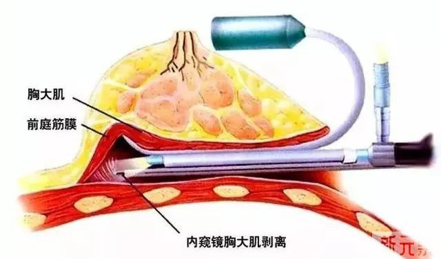 图解女生美丽胸型!圆盘型、水滴型、纺锤型...你想拥有哪种胸型? 图片-44