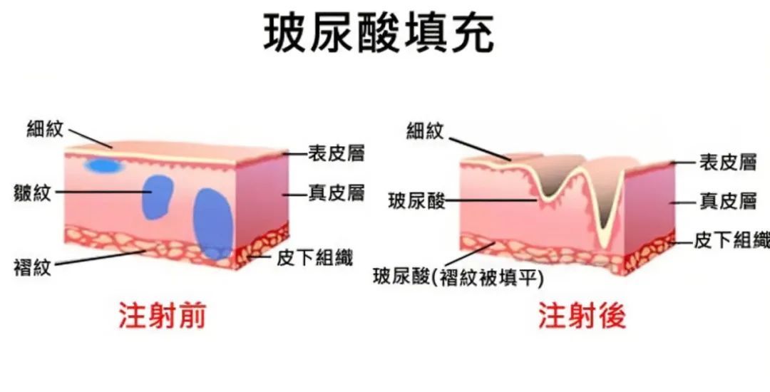 打玻尿酸，是不是越贵就越好? 图片-6