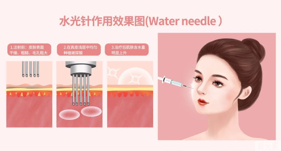 医美科普 | 水光针注射后为什么会反干反黑? 图片-3