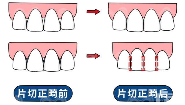 牙齿“黑三角”到底是什么来路?可以补救吗? 图片-9