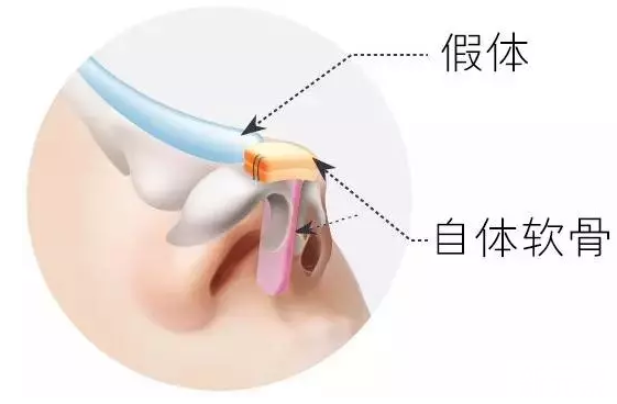 额部皮瓣鼻再造术——跨越三千年的继承与发展 图片-16