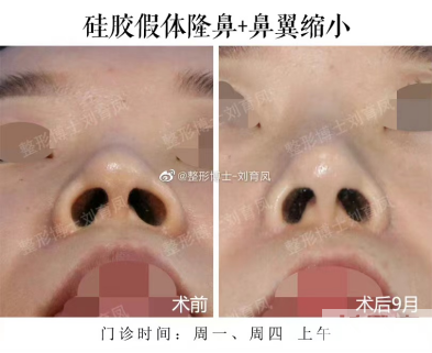 鼻整形，你有注意到这个地方吗? 图片-14