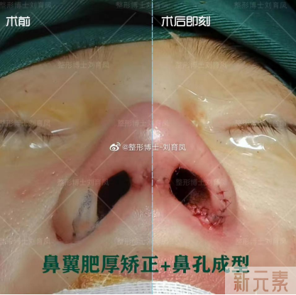 鼻整形，你有注意到这个地方吗? 图片-16