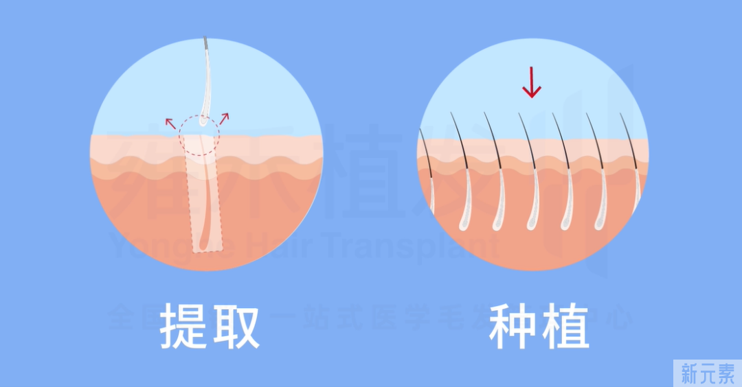 想植发，你该了解这些事 图片-4