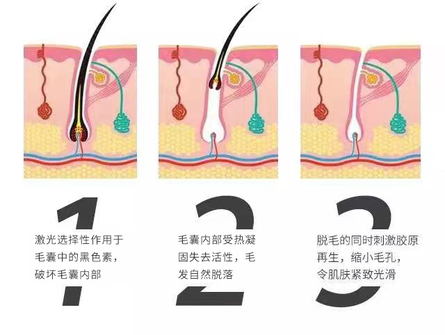夏天想摆脱浓密毛毛，你需要这份“安全脱毛指南” 图片-6