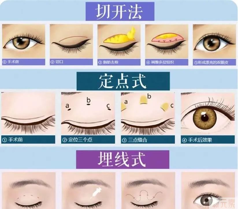 双眼皮手术参考指南 图片-3