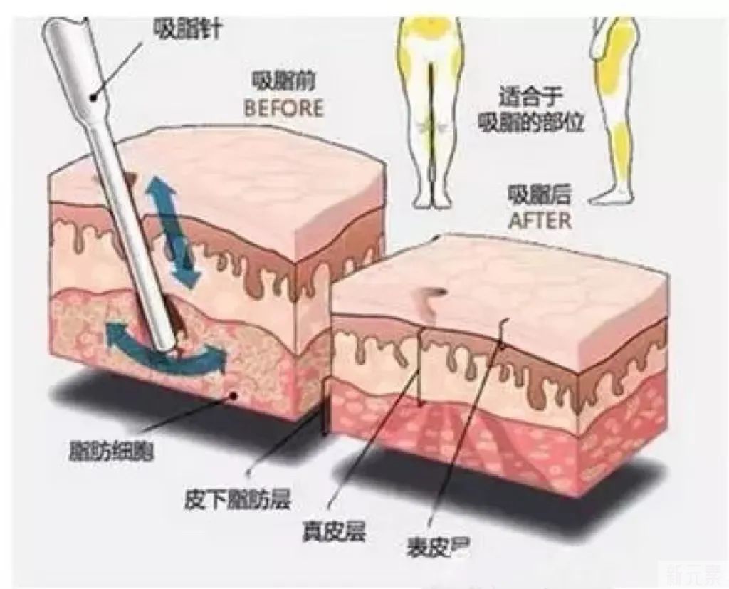 关于吸脂，你们关心的问题都在这里! 图片-7