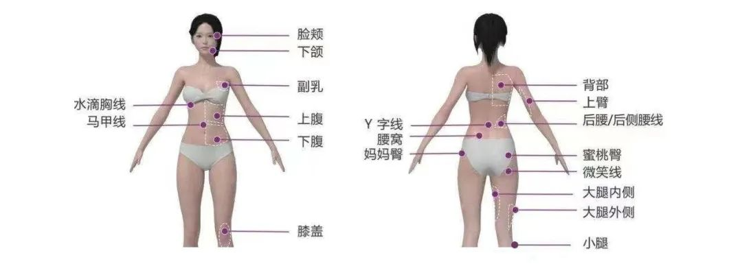 关于吸脂，你们关心的问题都在这里! 图片-6