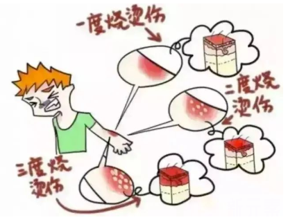 被烫伤后别慌，按这些方法处理可避免留疤，建议收藏~ 图片-6