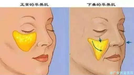 苹果肌到底是什么?这些方法轻松拥有 图片-2