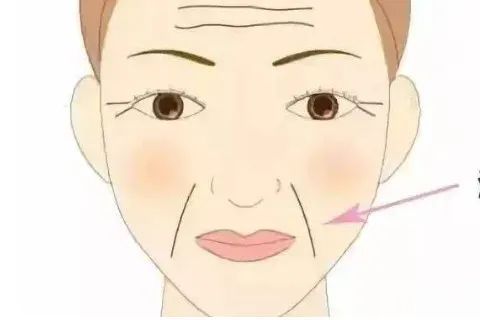 【医美小科普】法令纹应该如何消除，填充还是提拉 图片-1