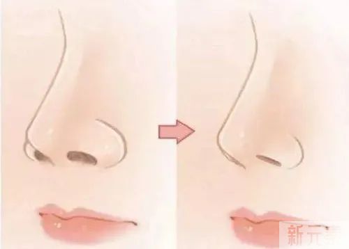 如果你塌鼻梁，鼻翼还肥大，除了垫高鼻尖和鼻梁，还得缩小鼻翼 图片-3
