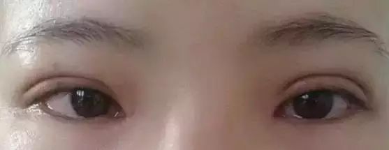 双眼皮做坏了能有多扎心?这类修复贵也有理由 图片-7