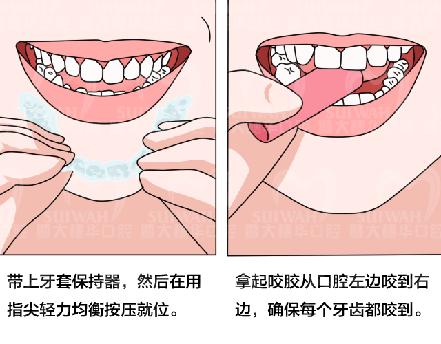 保持器是成人的“专利”吗?青少年矫正后，需不需要戴? 图片-4