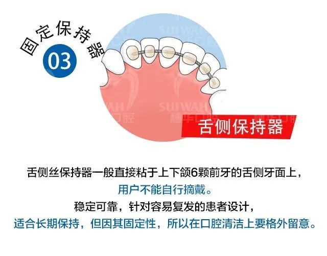 保持器是成人的“专利”吗?青少年矫正后，需不需要戴? 图片-8