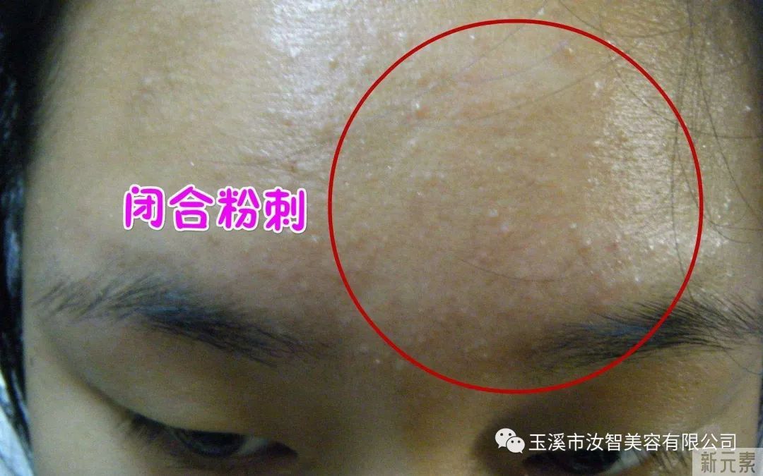 青春不“痘”留，用心和痘痘说拜拜! 图片-5