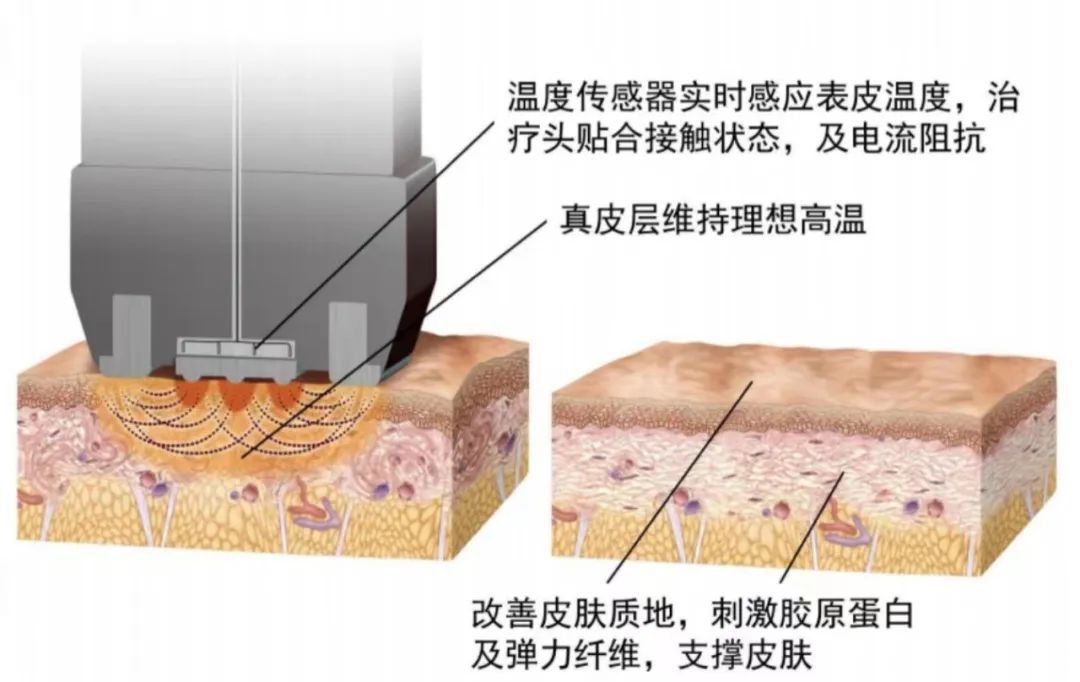 夏季溶脂塑形新姿态 图片-9