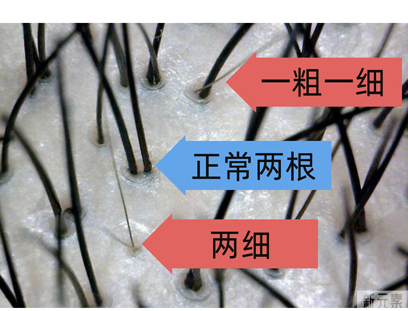 警惕“植发计费陷阱” ， 1 个毛囊≠1个毛囊单位 图片-3