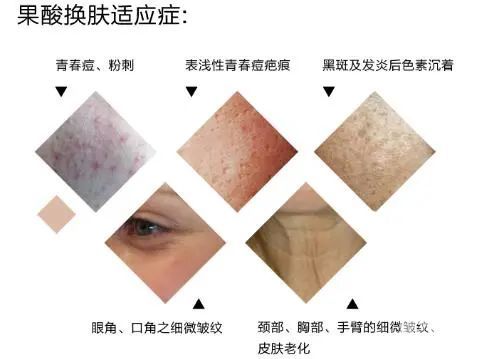 果酸焕肤到底如何?做完皮肤会变薄? 图片-10
