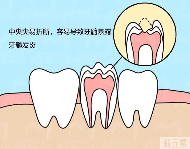 警惕!孩子恒牙萌出时，中间冒出一个白色“小尖尖” 图片-3