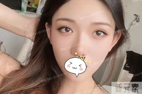 同样是do双眼皮，却能做到比别人自然好看，原因在哪? 图片-11
