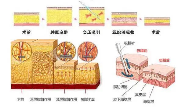【医美小科普】做完吸脂以后的皮肤会不会变的很松弛? 图片-2