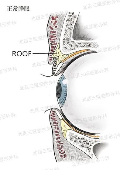 肿眼泡都是因为脂肪肥厚形成的吗? 图片-1