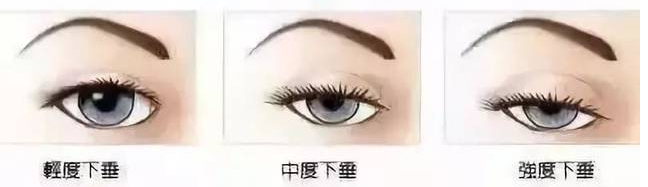 做了双眼皮为什么还要开眼角? 图片-9