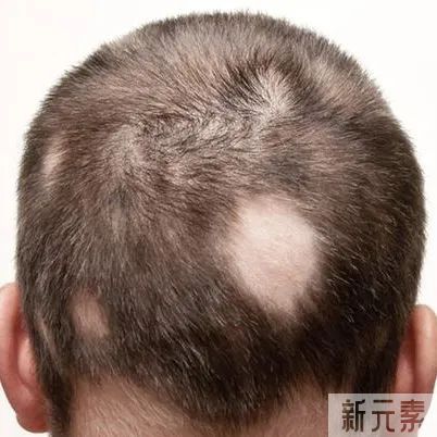 脱发种类详解! 图片-3