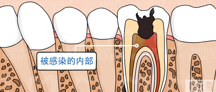 什么是显微根管?它与传统根管治疗有什么区别? 图片-2