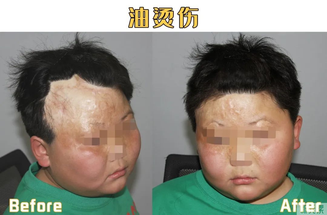为什么疤痕植发比普通植发难? 图片-4