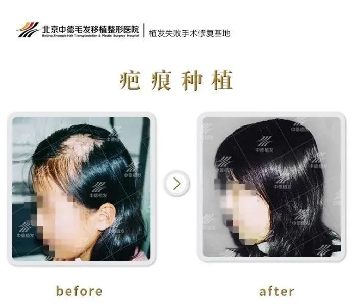 为什么疤痕植发比普通植发难? 图片-2