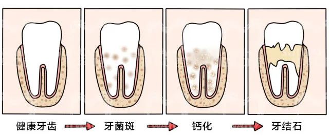 这个蛀牙的“信号”，你注意到了吗? 图片-9