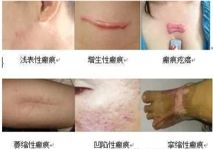 到底花多少钱能将疤痕治好?一篇文章跟你说清楚 图片-4