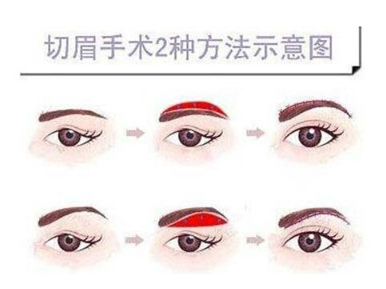 改善上睑松弛，重回“睛”彩人生 图片-8
