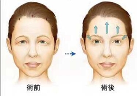 改善上睑松弛，重回“睛”彩人生 图片-13