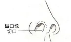 避坑| 这些功课才是「有效隆鼻」该做的 图片-6