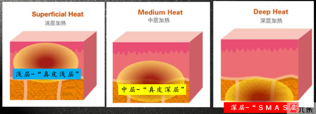 干货丨还在混淆热玛吉&热拉提?一篇帮你弄明白! 图片-6