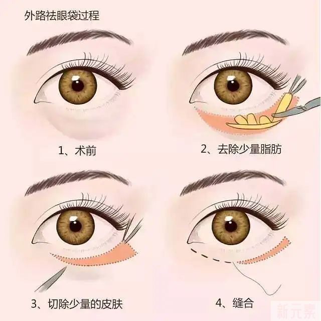 眼袋手术实话公开，医生大揭秘 图片-4