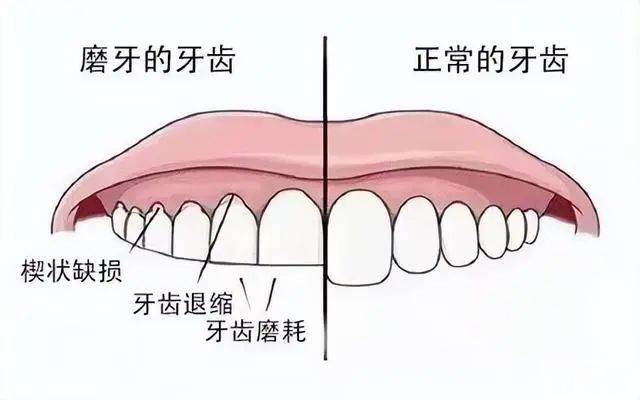 吃饭总咬腮帮子?小心咬颊症! 图片-9