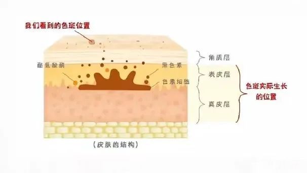 警惕陷阱!激光祛斑反而加重了，是咋个回事? 图片-3