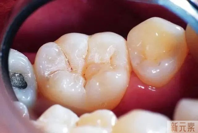 你的孩子需要做窝沟封闭吗?医生来告诉你! 图片-7