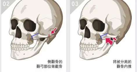 哈?徒手整骨真的能改善脸型? 图片-7