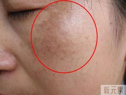 夏季不防晒，脸上会长多少斑?答案超乎你想象 图片-3