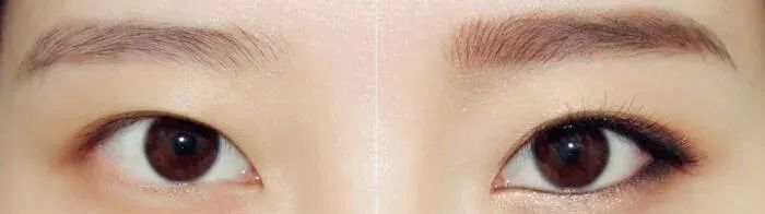 之前做了窄了的双眼皮，修复宽些能自然吗? 图片-6