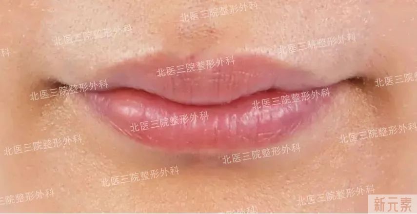 唇部不明注射物的取出与修复 图片-4