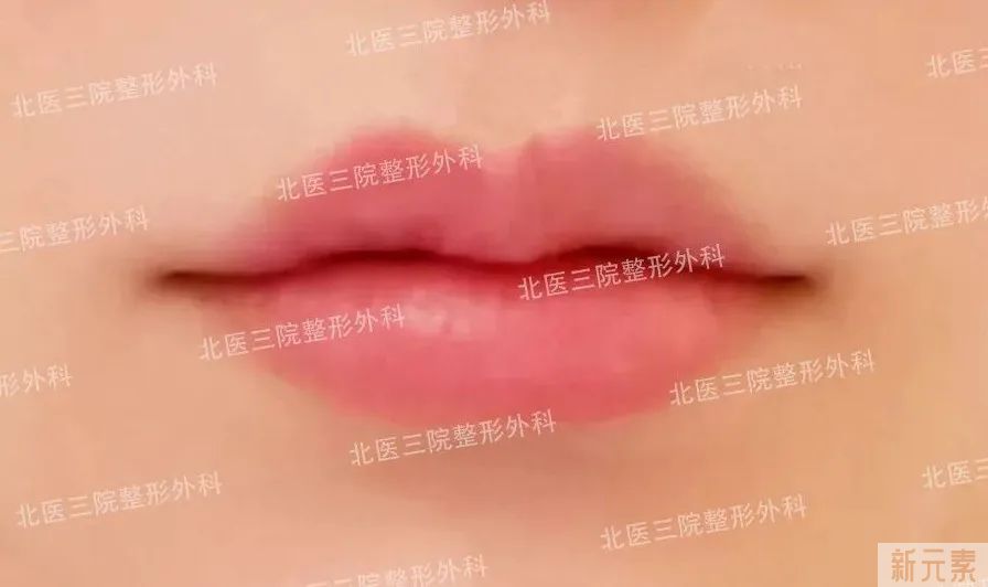唇部不明注射物的取出与修复 图片-6